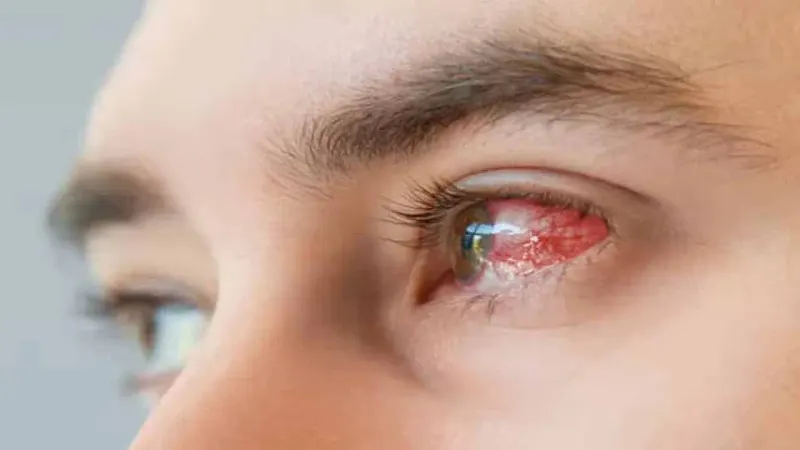 Schools to remain closed tomorrow amid rising cases of Pink Eye infection