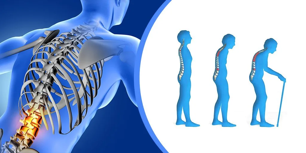 Osteoporosis
