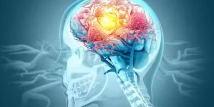 New Research Reveals Potential Way to Restore Sleep in Alzheimer's Disease